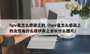 hpv是怎么感染上的（hpv是怎么感染上的女性有什么症状身上会长什么图片）